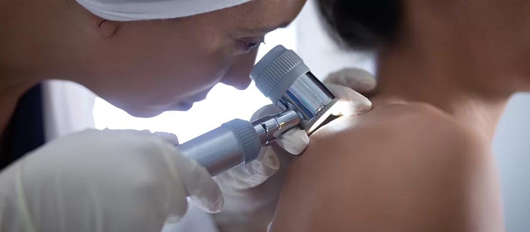 mole skin cancer malaysia